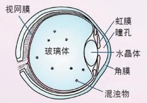 眼部漂浮物