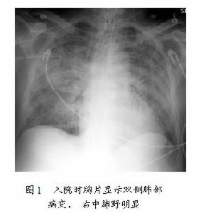 老年呼吸衰竭