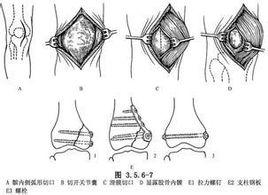 股骨髁部骨折內固定術