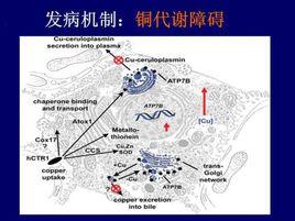 銅代謝障礙症