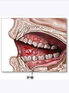 牙齦癌