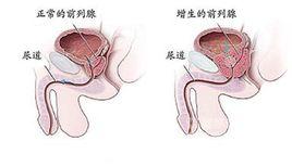 前列腺增生防治要訣