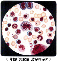 原發性骨髓纖維化