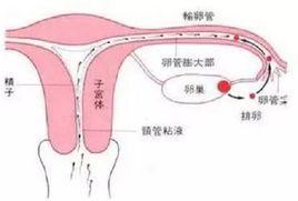 輸卵管性不孕症