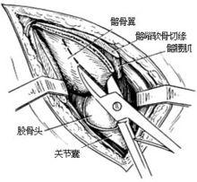 示意圖4:從髂骨嵴上採取楔形骨塊