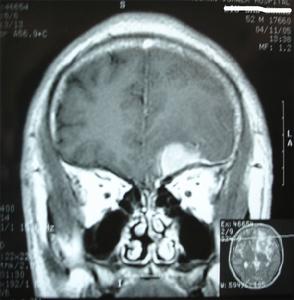 蝶骨腦膜瘤的眼眶病變