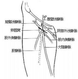 大隱靜脈高位結紮