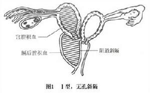 陰道斜隔