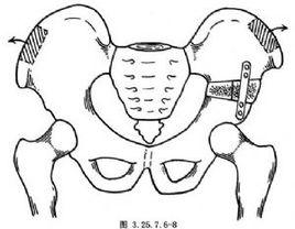 髂骨截骨延長術