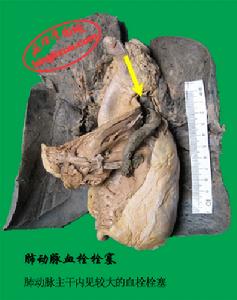 急性肺原性心臟病