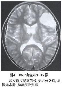 神經元腫瘤和神經元與神經膠質混合性腫瘤