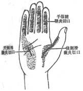 手指急性化膿性腱鞘炎