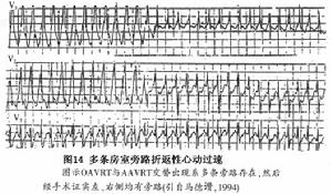 房室折返性心動過速