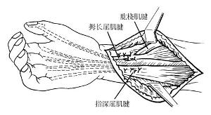 正中神經損傷