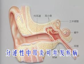 中耳炎的併發症