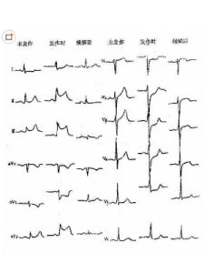 心肌缺血