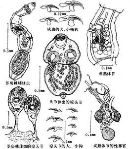 多房棘球蚴病