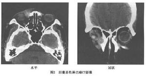 淚囊腫瘤