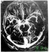 腦靜脈畸形血管造影