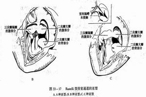 繼發性心房間隔缺損