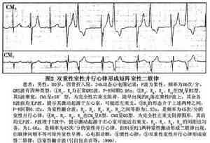 室性並行心律及室性並行心律性心動過速