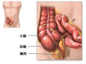 盲腸炎