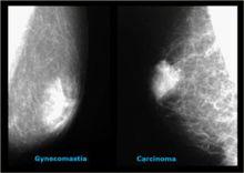 男子乳腺發育與乳腺癌的鉬靶X線顯像