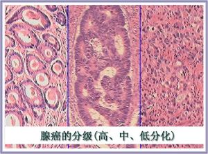 腫瘤的異型性