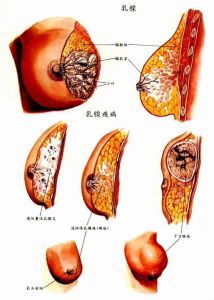 乳腺癌術後併發症