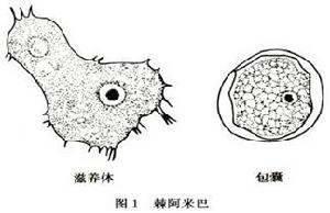 棘阿米巴性角膜炎