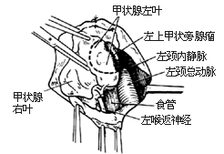 甲狀旁腺切除術