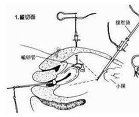 結紮手術