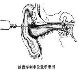 小兒急性中耳炎