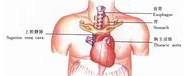 示意圖10:將胃底經食管床提至左頸部切口
