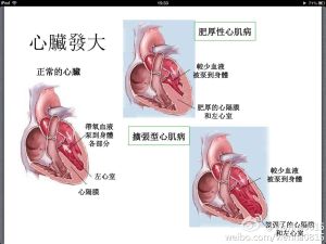 心肌病