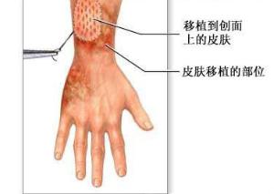 皮膚移植