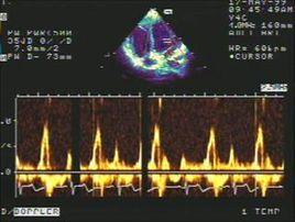 頻譜都卜勒超聲心動圖