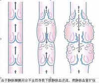 靜脈瓣膜閉合不全致靜脈血逆流靜脈血管擴張