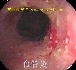 急性腐蝕性食管炎