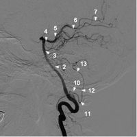 椎動脈造影2