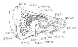 特發性面神經癱瘓