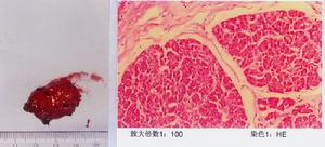 胰腺異位