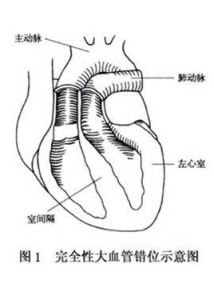 完全性大動脈轉位