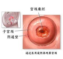 通過醫用窺陰器觀察宮頸