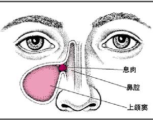 慢性副鼻竇炎