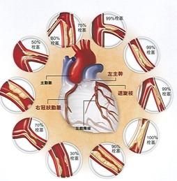 冠心病