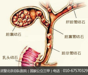 膽囊結石微創技術