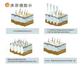 OS像素雷射