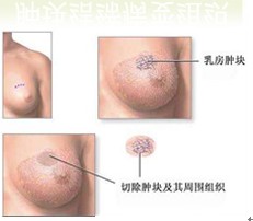 乳腺增生症