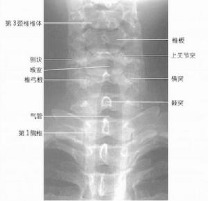 頸椎炎